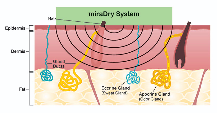 狐臭 miradry 清新微波